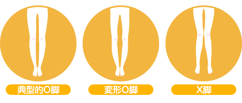 O脚の種類
